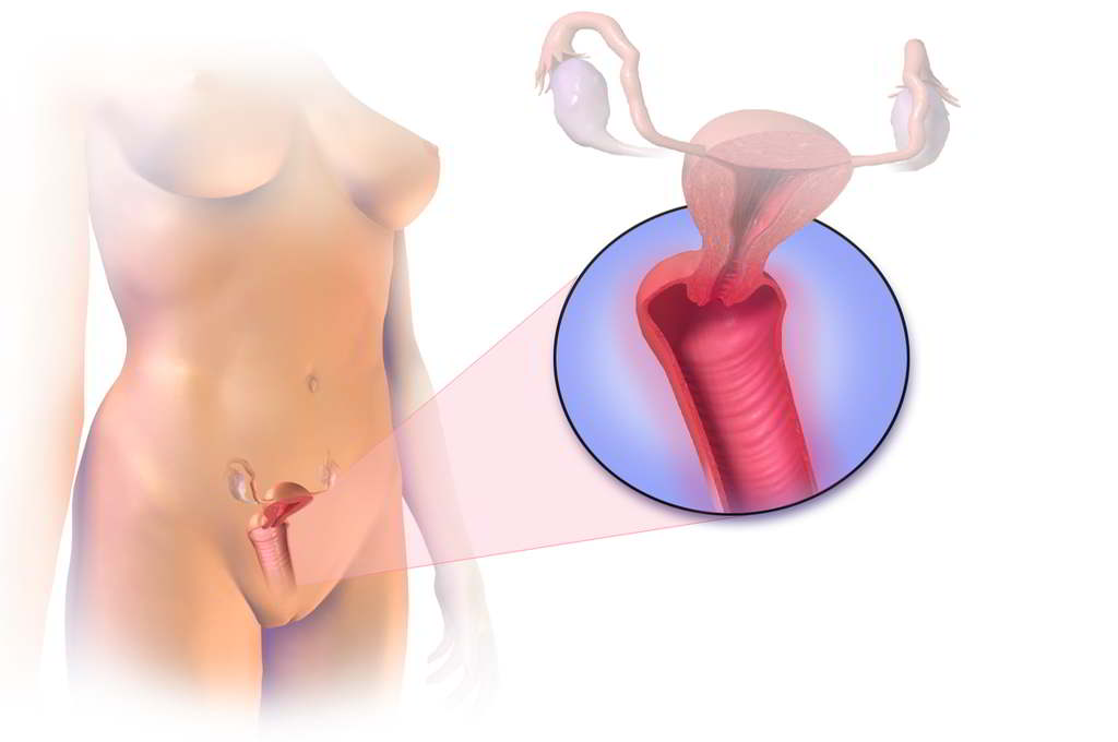 Tratamiento-para-vaginitis-en-Lima
