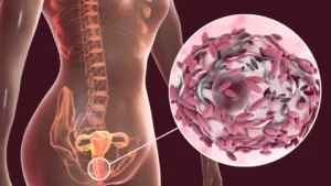 Vaginosis bacteriana